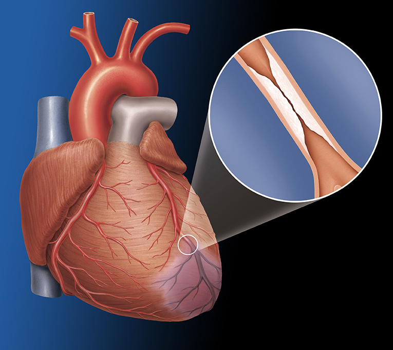 St&eacute;nose/r&eacute;tr&eacute;cissement cardiaque